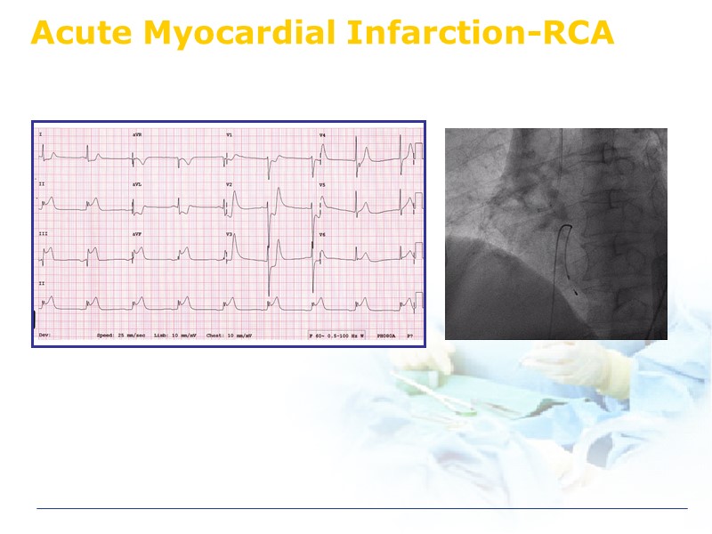 Acute Myocardial Infarction-RCA